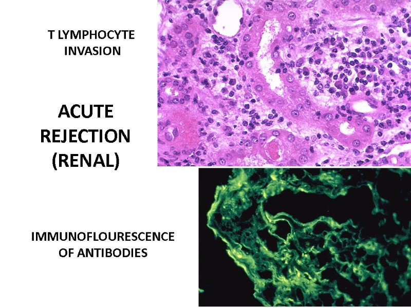 ACUTE  REJECTION  (RENAL) T LYMPHOCYTE  INVASION IMMUNOFLOURESCENCE OF ANTIBODIES